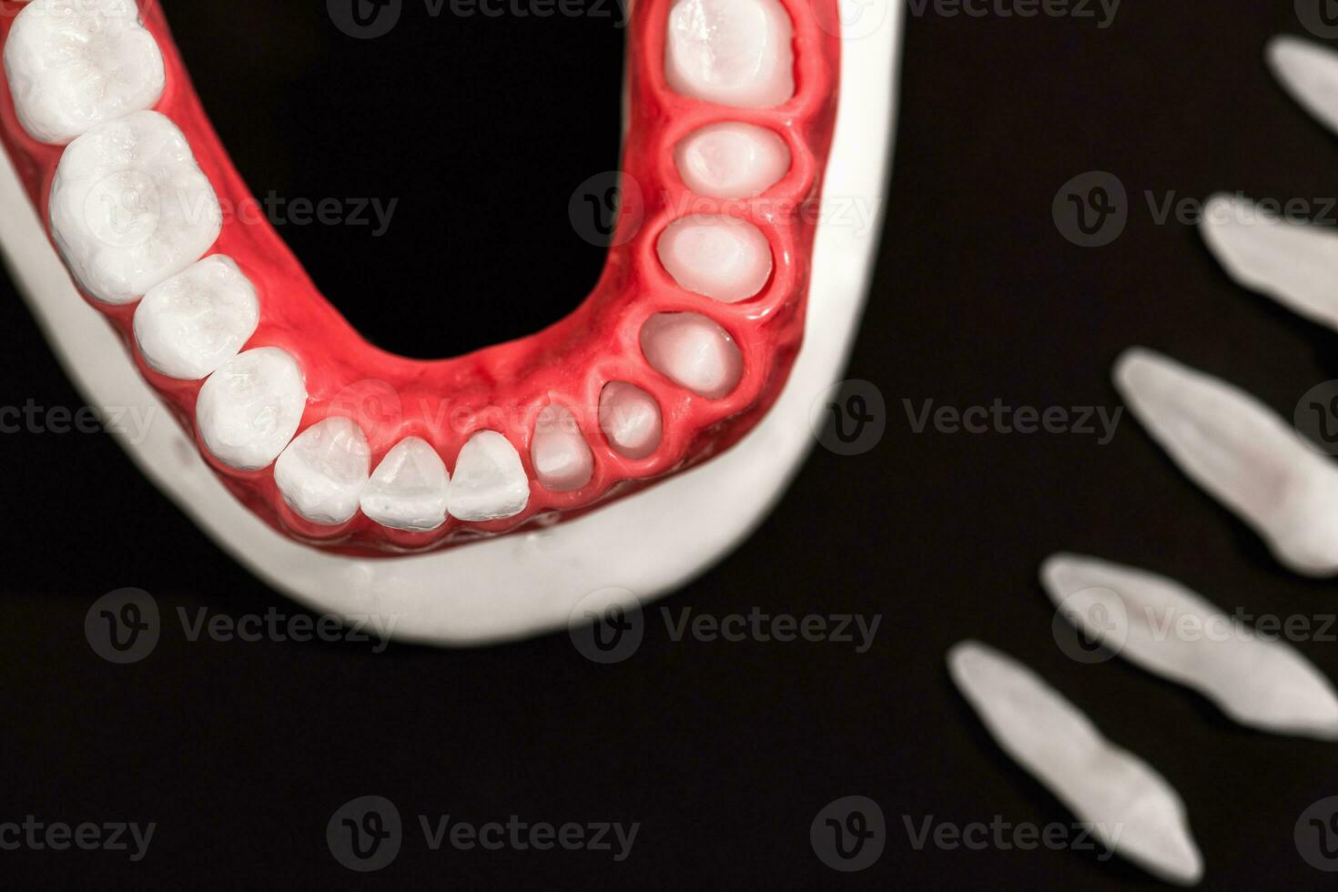 Teeth implant and crown installation process parts isolated on a black background. Medically accurate 3D model. photo