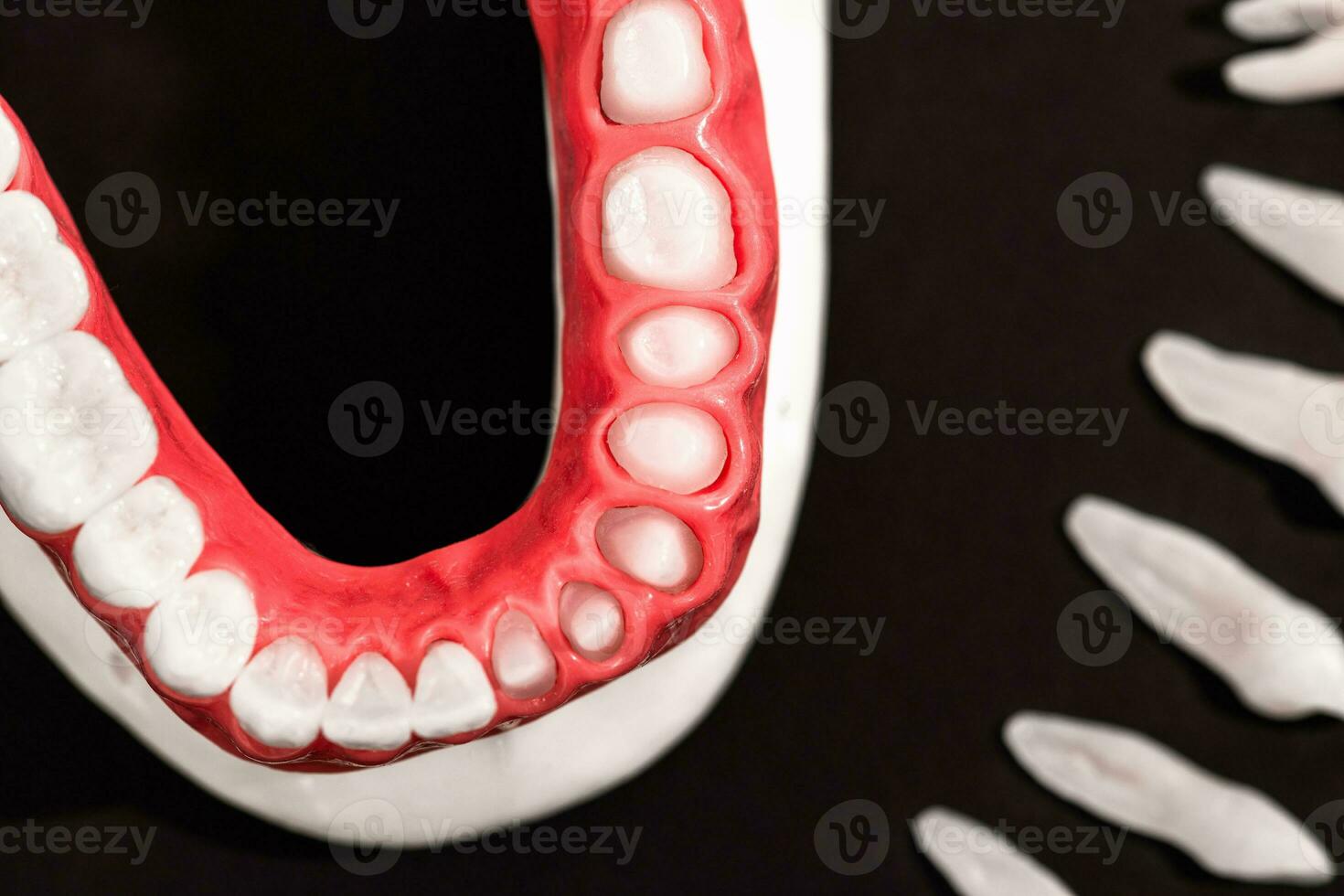 Teeth implant and crown installation process parts isolated on a black background. Medically accurate 3D model. photo