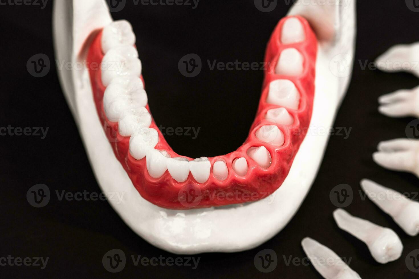 Teeth implant and crown installation process parts isolated on a black background. Medically accurate 3D model. photo