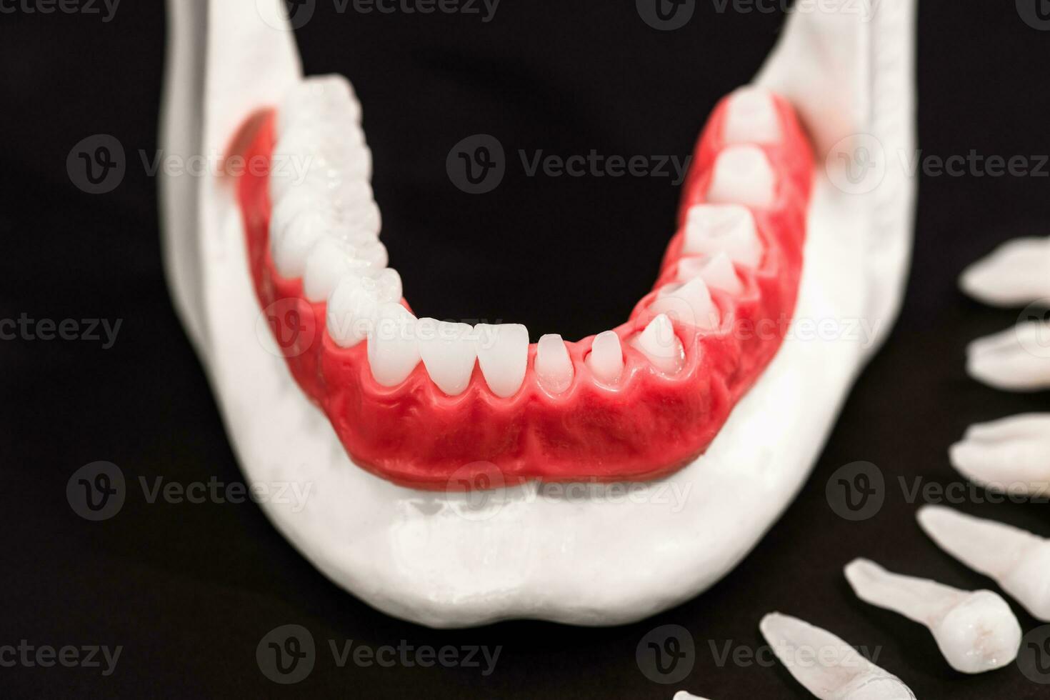 Teeth implant and crown installation process parts isolated on a black background. Medically accurate 3D model. photo
