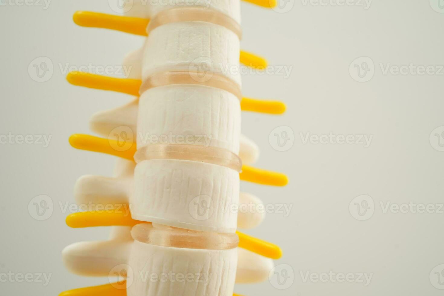 Spinal nerve and bone, Lumbar spine displaced herniated disc fragment, Model for treatment medical in the orthopedic department. photo