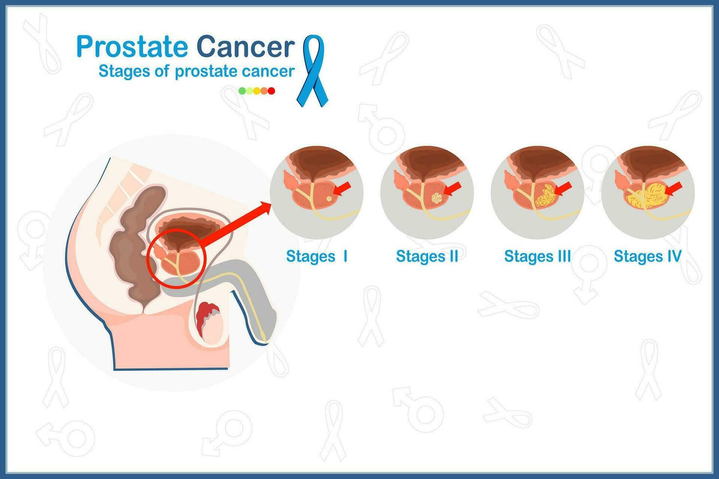 Flat medical vector illustration concept of 4 stages of prostate cancer on white background with blue ribbon