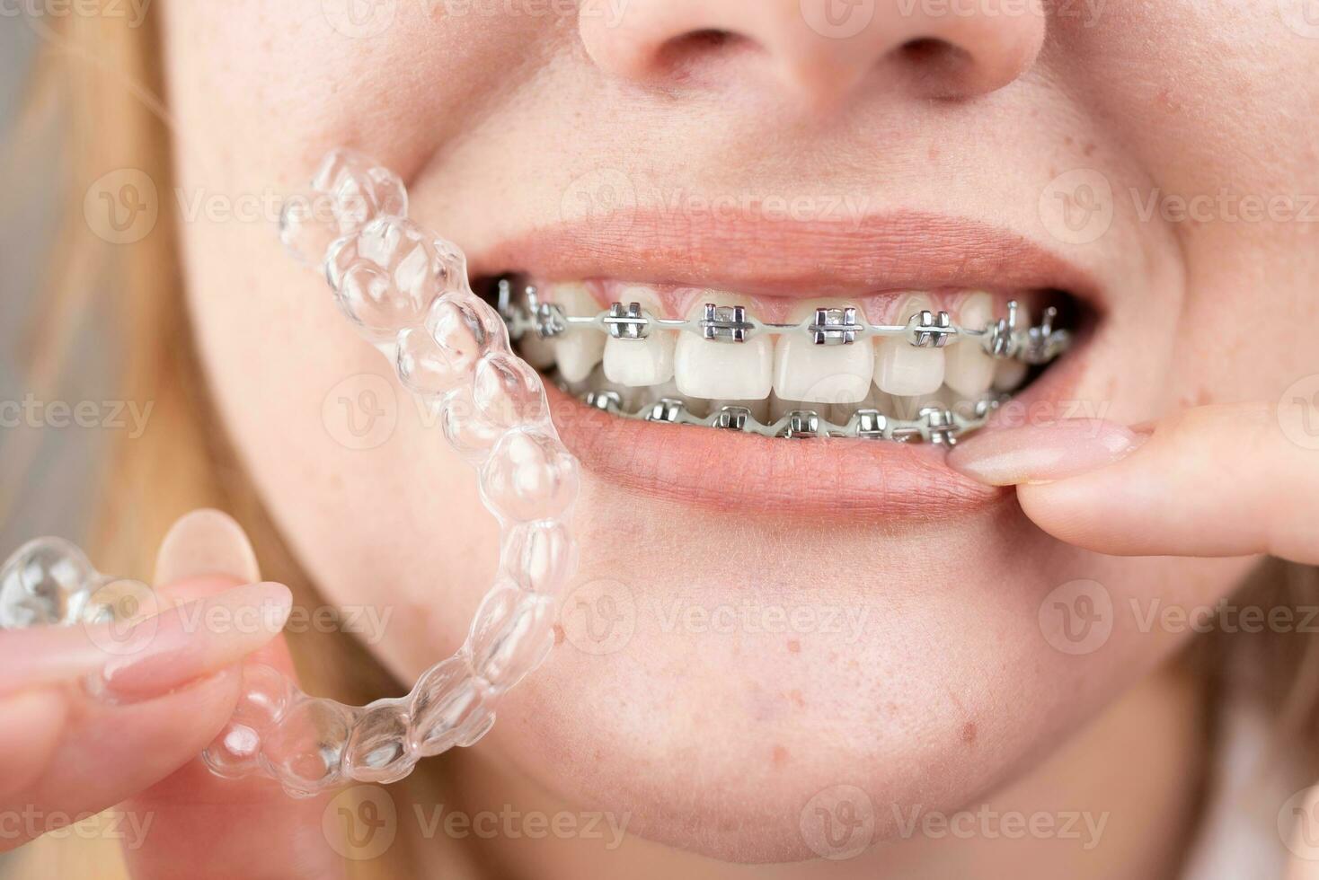 dental cuidado.sonriendo niña con tirantes en su dientes sostiene alineadores en su manos y muestra el diferencia Entre ellos foto