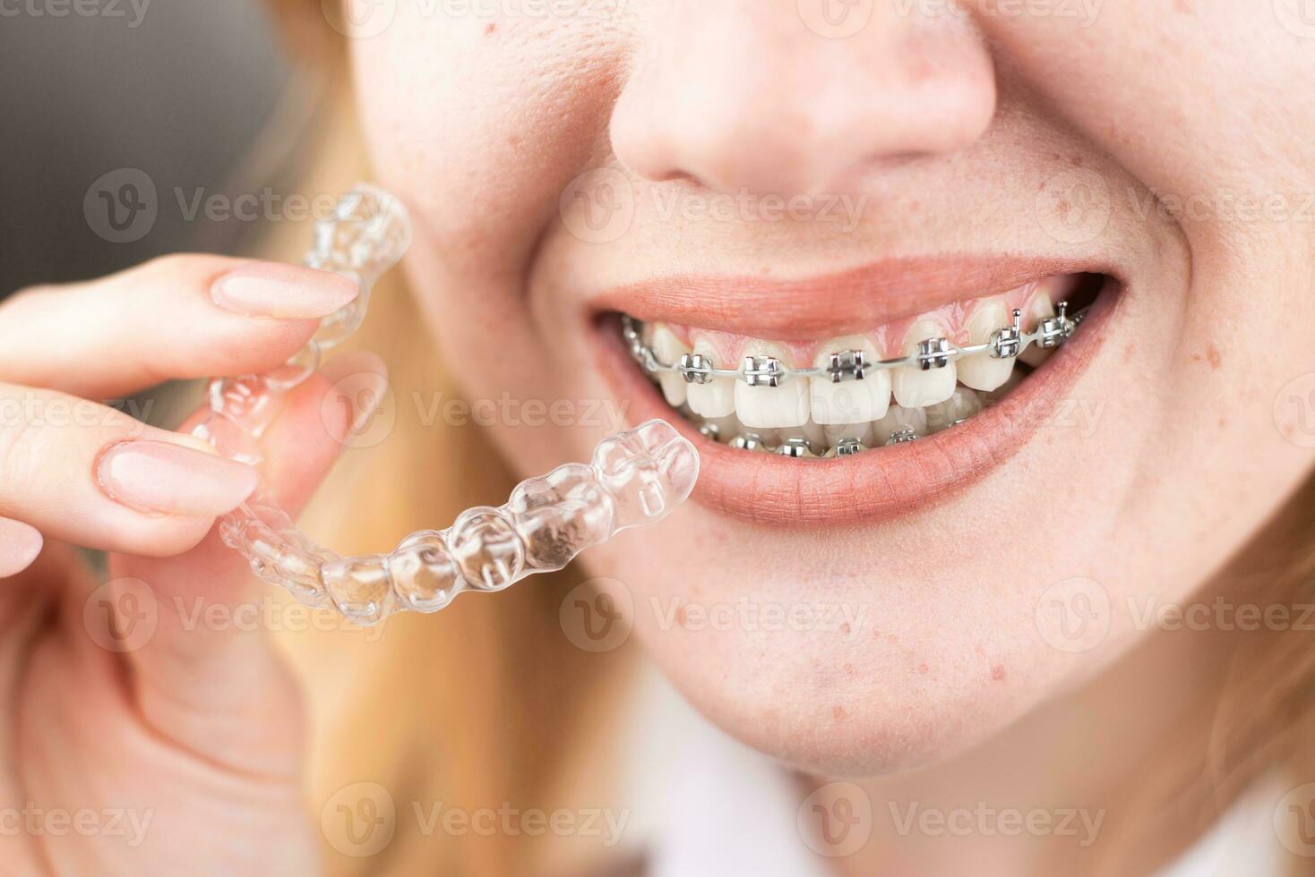 dental cuidado.sonriendo niña con tirantes en su dientes sostiene alineadores en su manos y muestra el diferencia Entre ellos foto