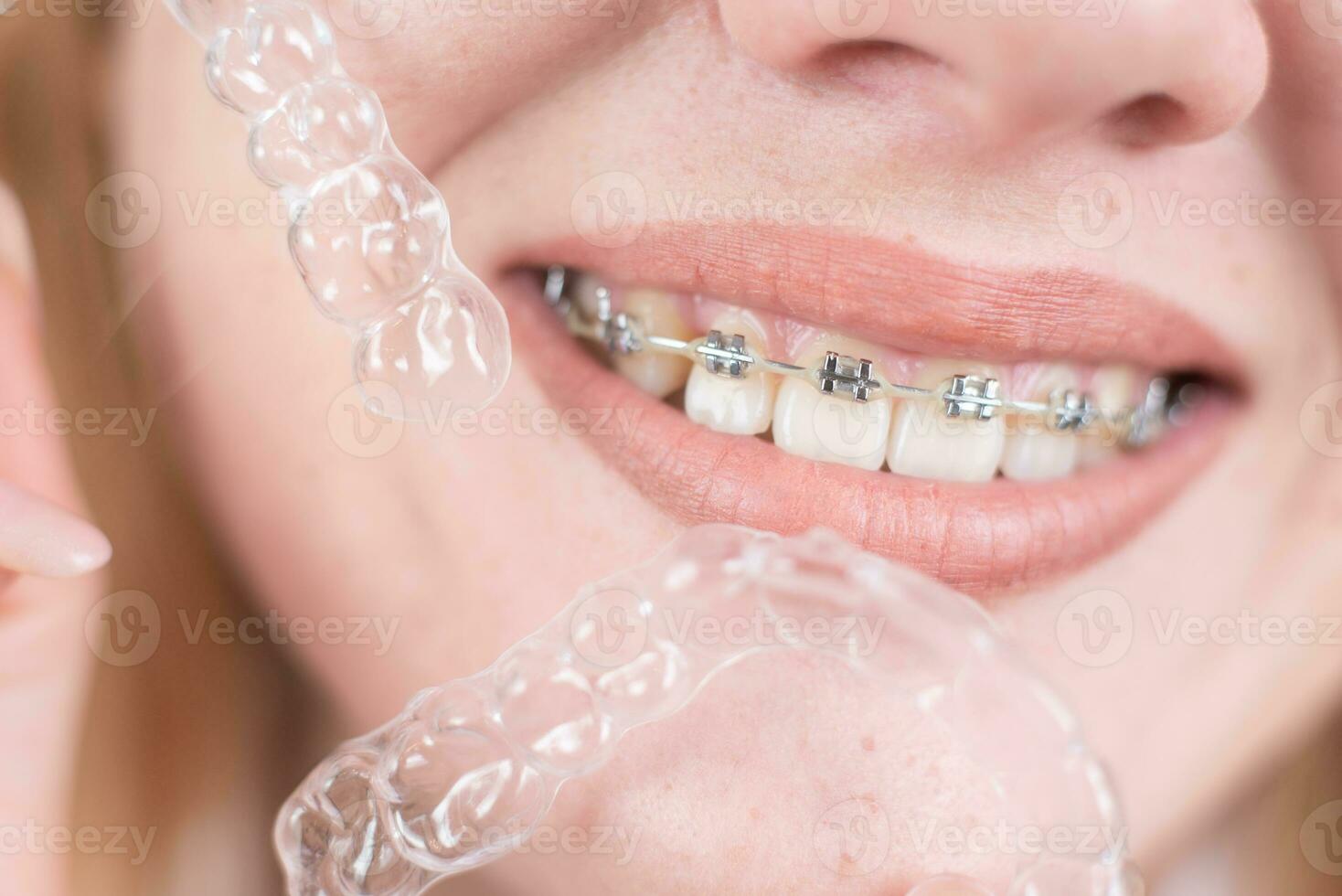 dental cuidado.sonriendo niña con tirantes en su dientes sostiene alineadores en su manos y muestra el diferencia Entre ellos foto