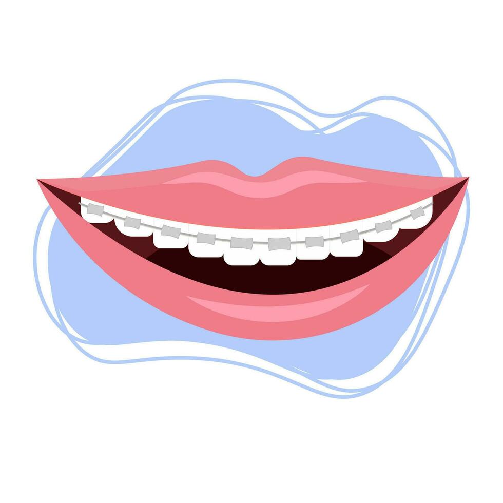 Smile with braces, brekets stock vector illustration isolated on white background. Stomatology, orthodontic, healthcare concept. Dental equipment for correction. White teeth, hygiene.