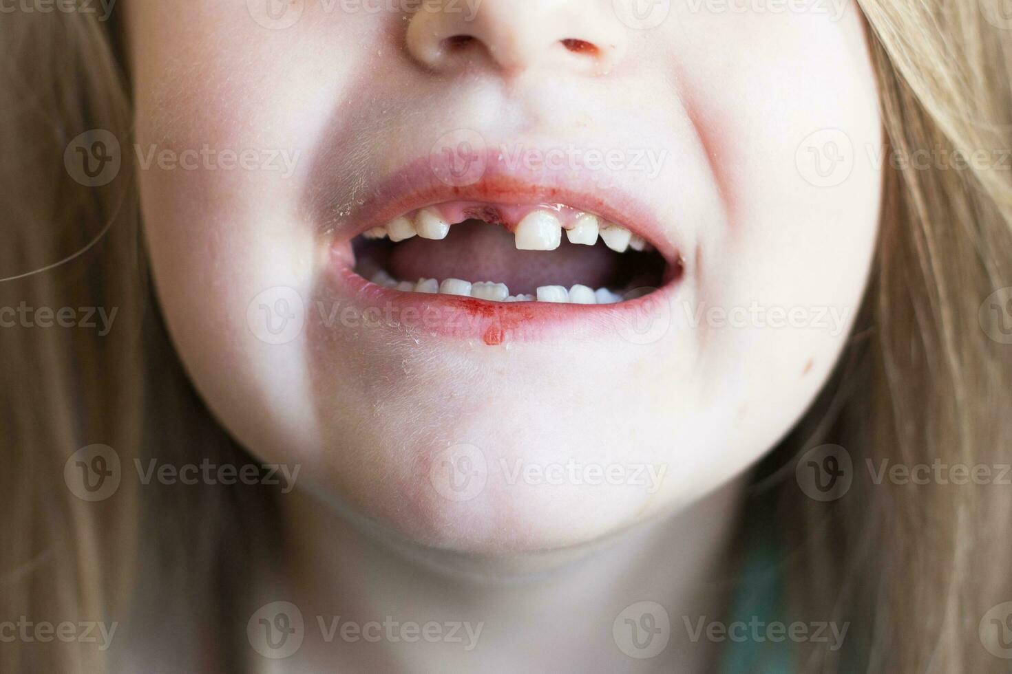 A little cute girl lost her front baby milk tooth. Lost temporary tooth. photo