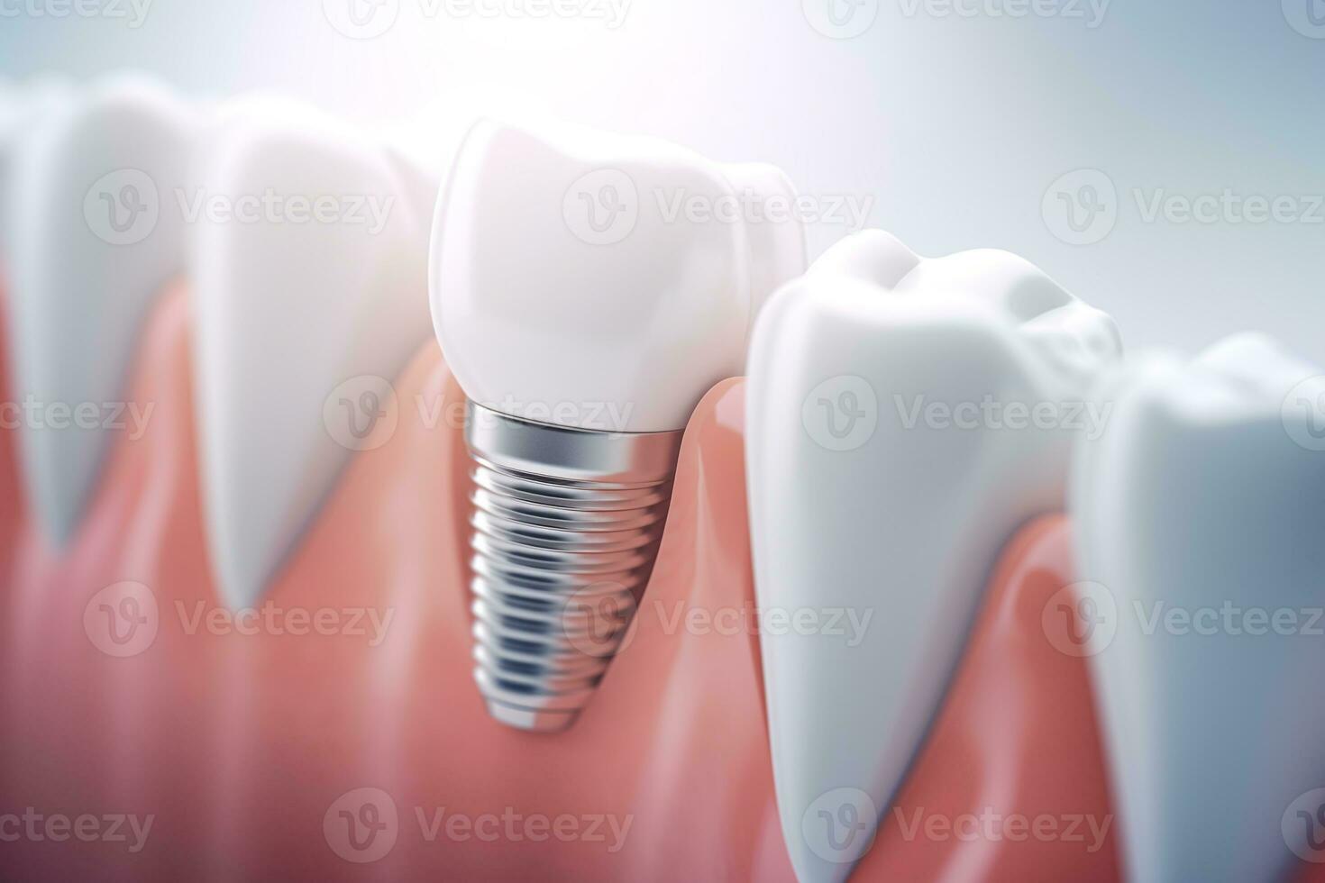 3D generated dental teeth implant.Health concept.Created with Generative AI technology. photo