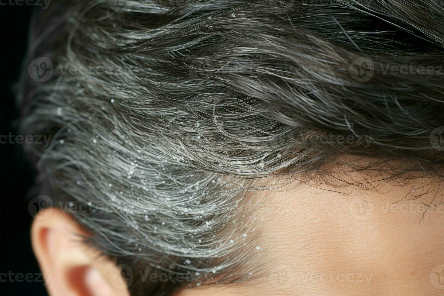 Up close view of a mans hair displaying dandruff issues AI Generated photo