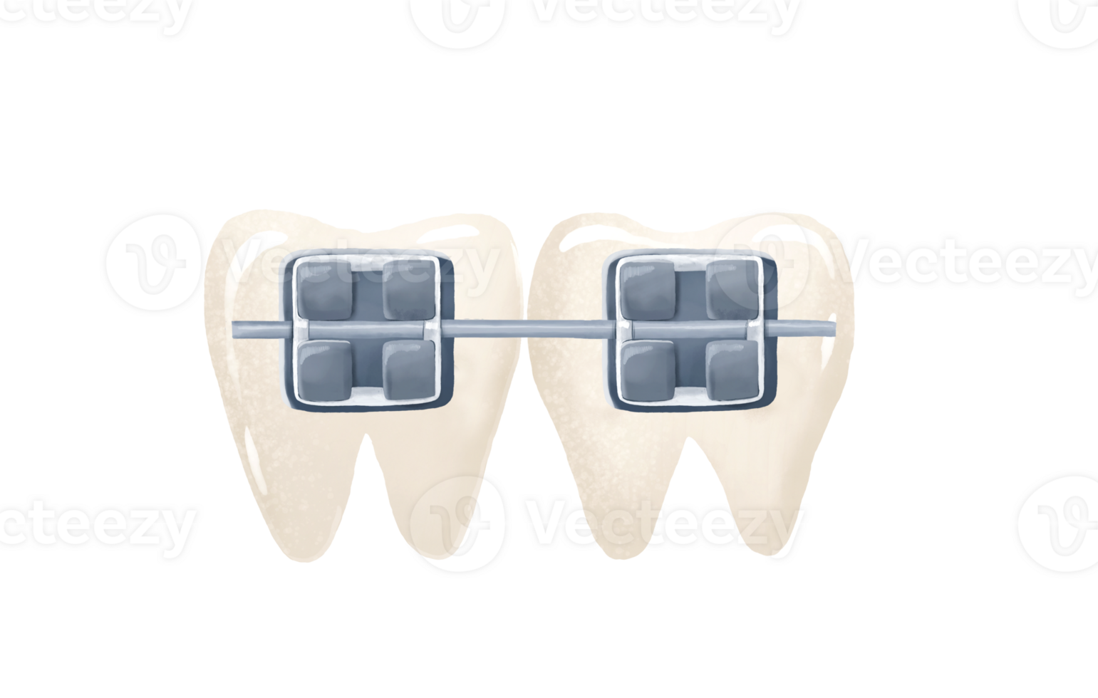 White teeth and metal braces. Orthodontic treatment. Baby cute isolated illustration on  transparent background. png