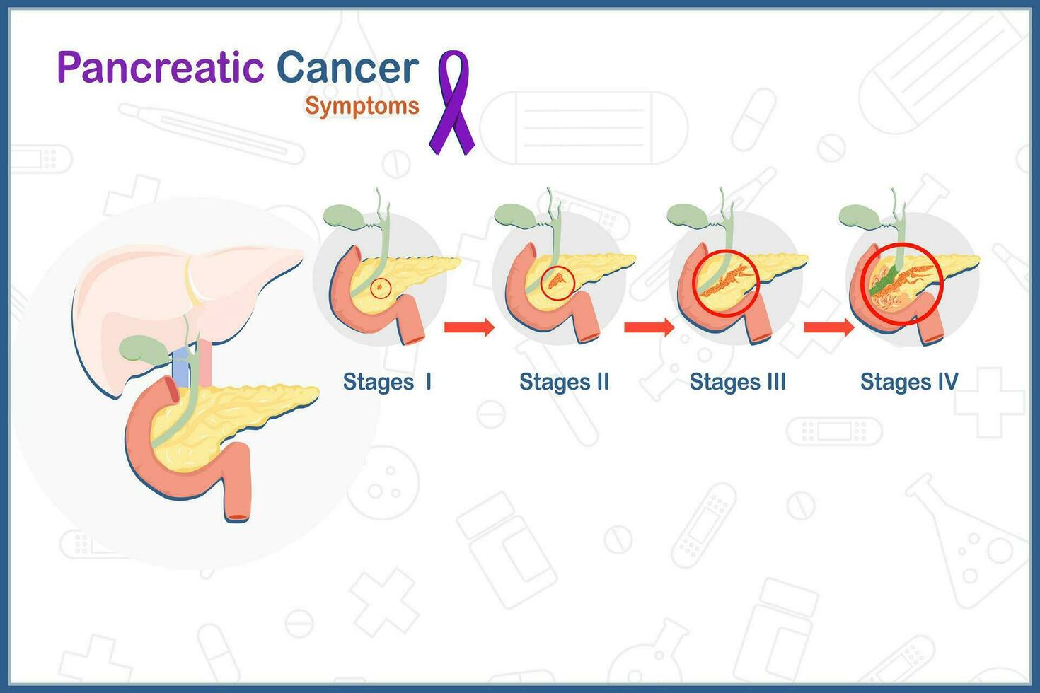 Flat illustration in healthcare concept of pancreatic cancer. Purple ribbon symbol pancreatic cancer and the 4 stages of pancreas,isolated on white background. vector