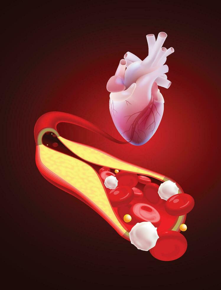 3D illustration of a blocked human coronary artery presents a close-up view of the blood vessel cross-section and dissecting it to reveal the inside. vector