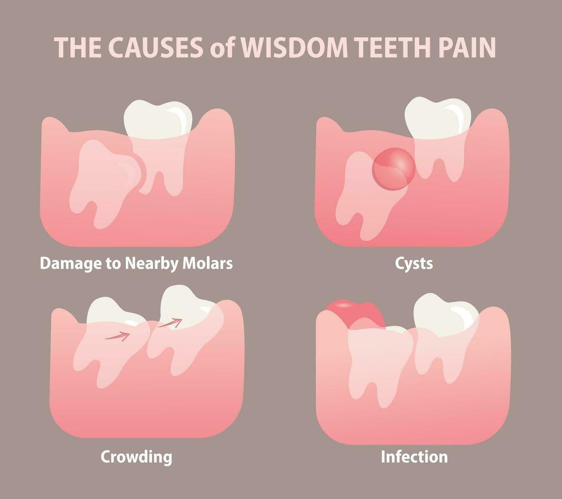 the causes of Wisdom tooth pain illustration 31744570 Vector Art at