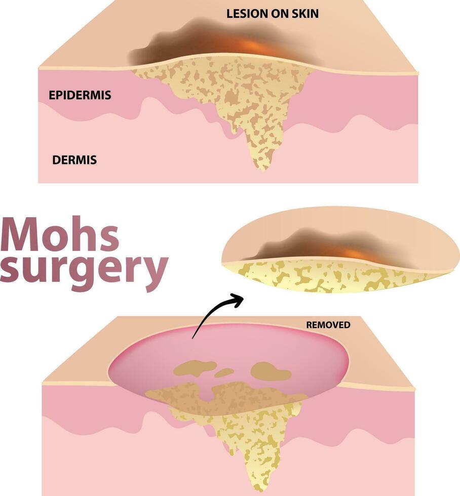 illustration of Mohs Surgery vector