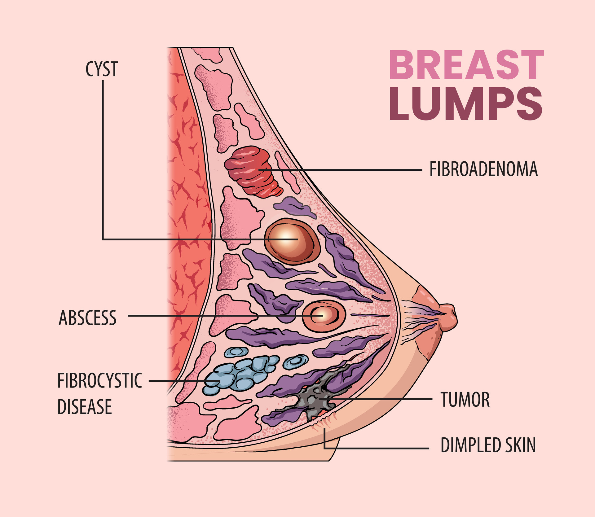 illustration of breast lumps types in women 31744578 Vector Art at