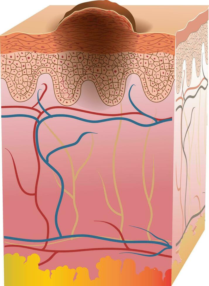 skin cancer cross section illustration vector