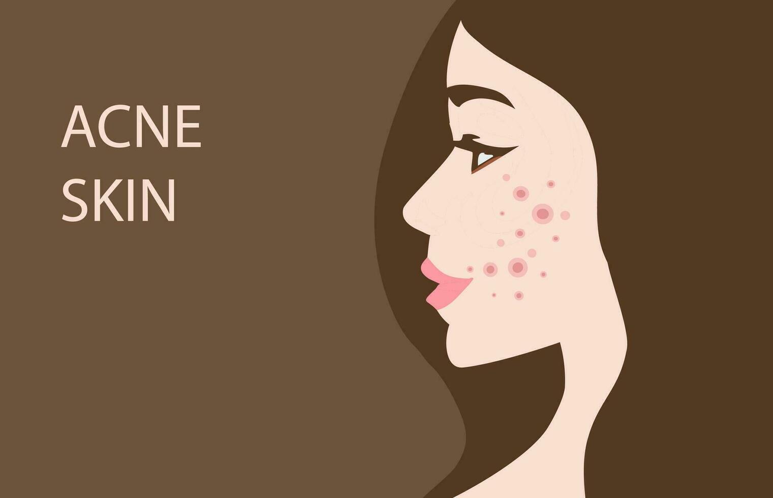 Woman face with skin acne, pimples, blackheads vector illustration. Acne skin face problem concept