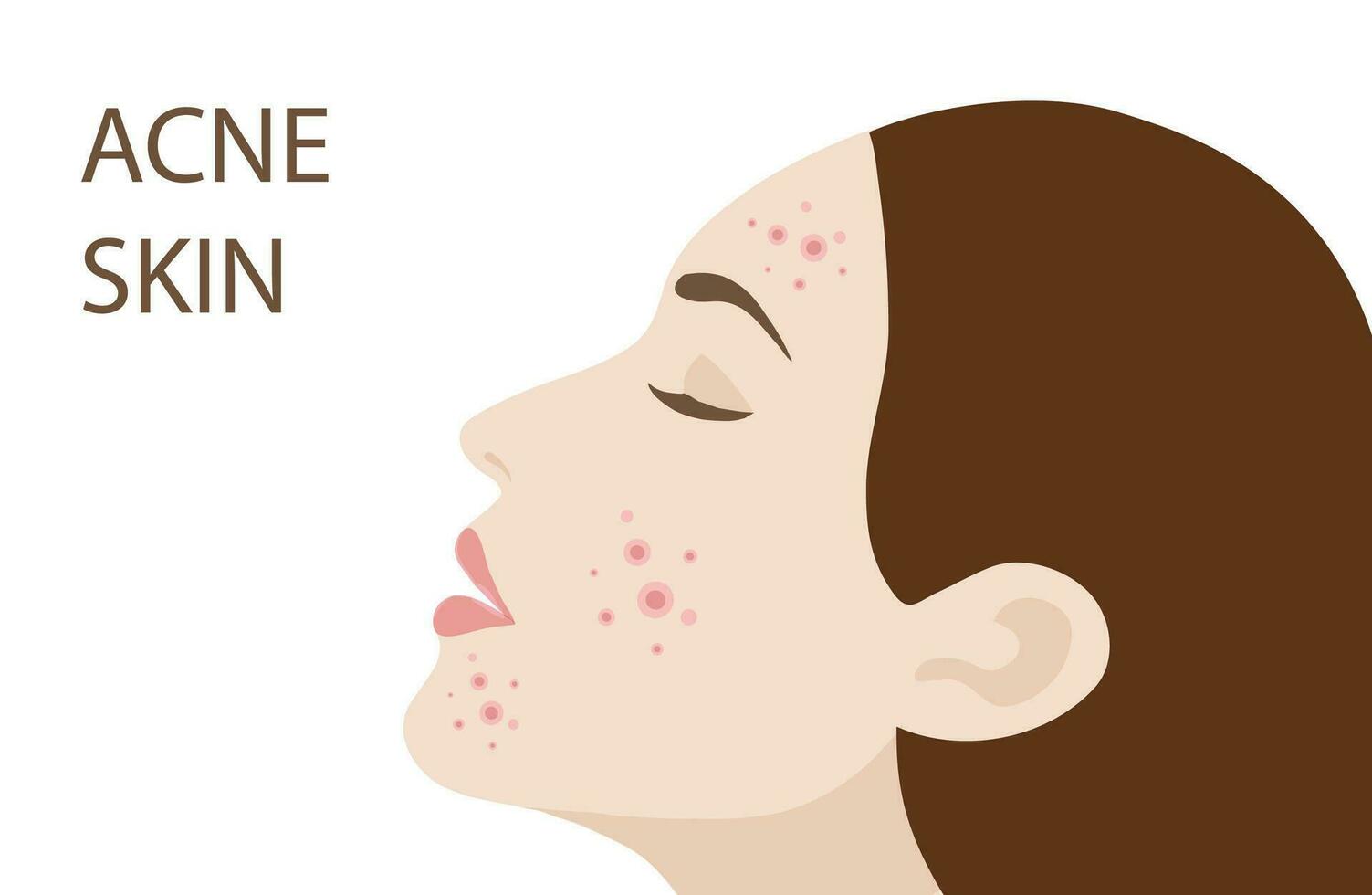 Woman face with skin acne, pimples, blackheads vector illustration. Acne skin face problem concept
