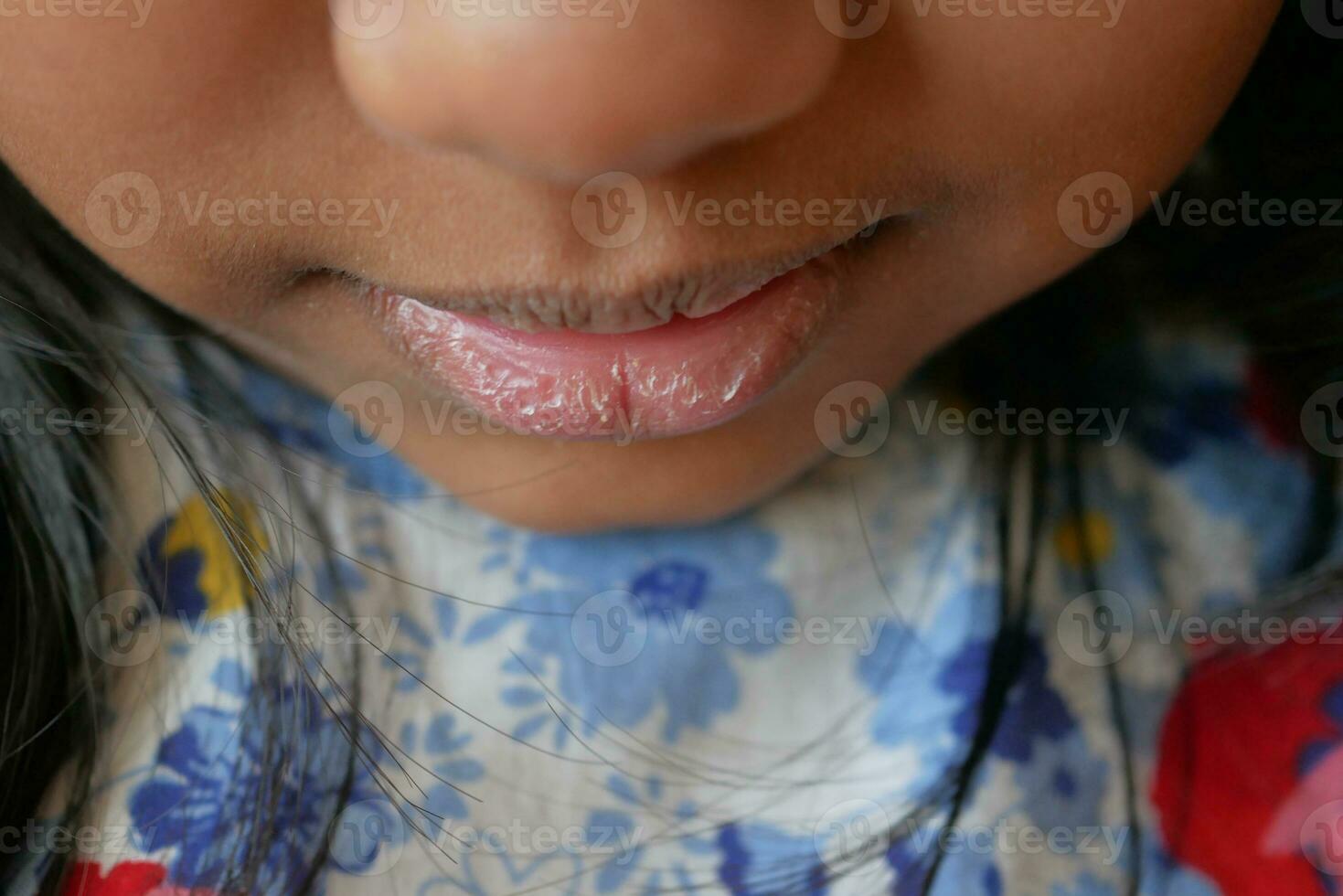 close up of dry lip of a child photo