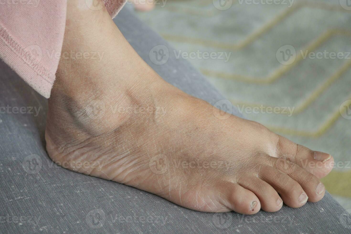 close up of women feet with swelling photo