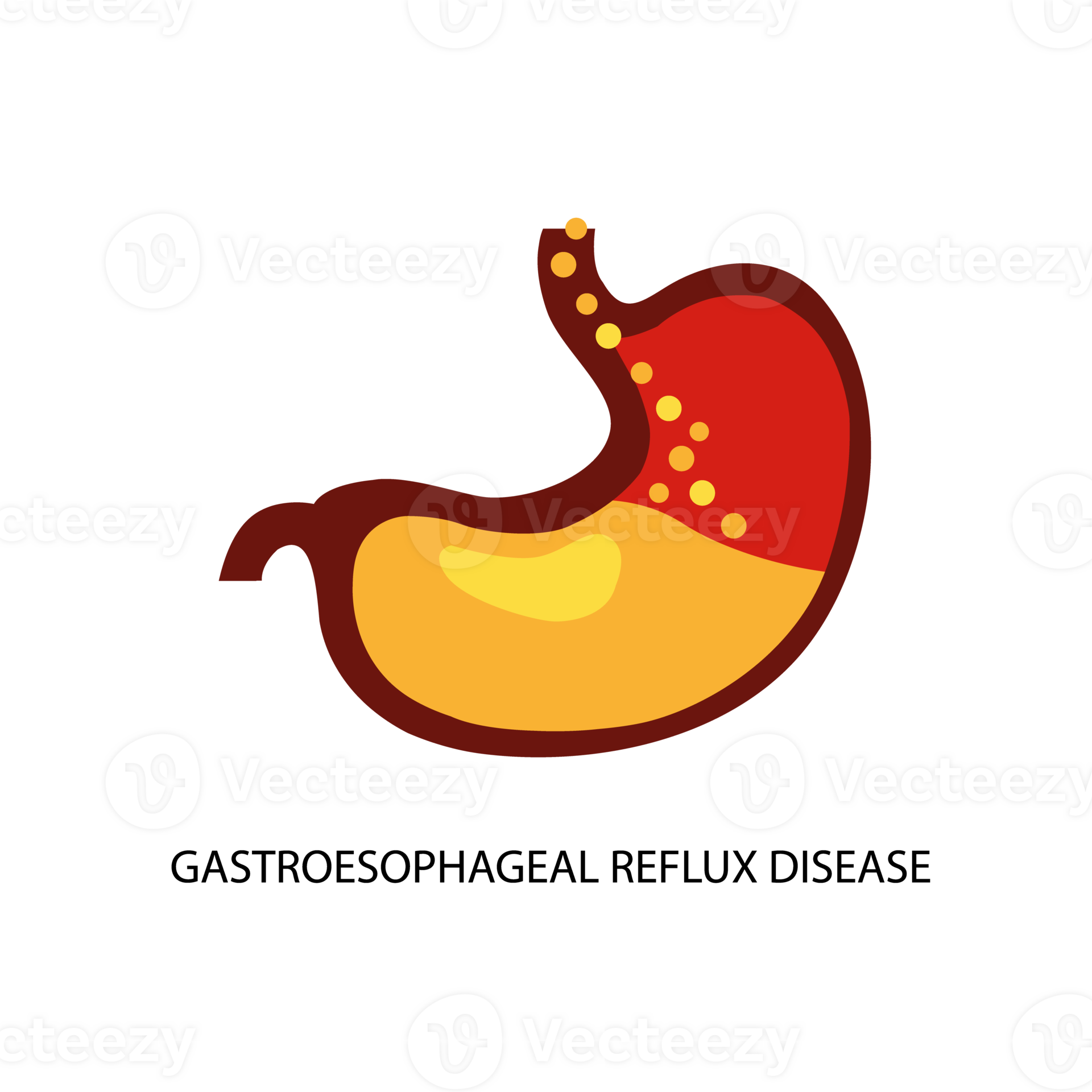 Gastroesophageal reflux disease. Stomach GERD heartburn esophagus medical illustration. 32041949 PNG
