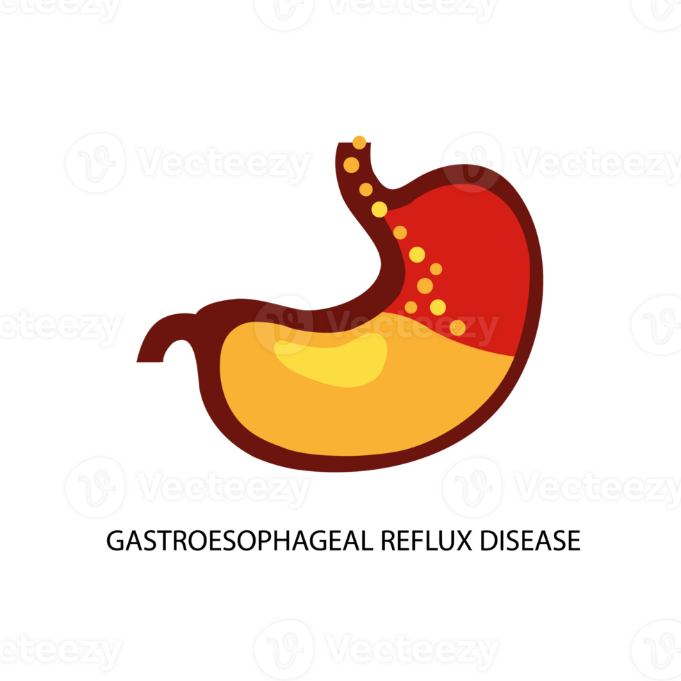 Gastroesophageal reflux disease. Stomach GERD heartburn esophagus