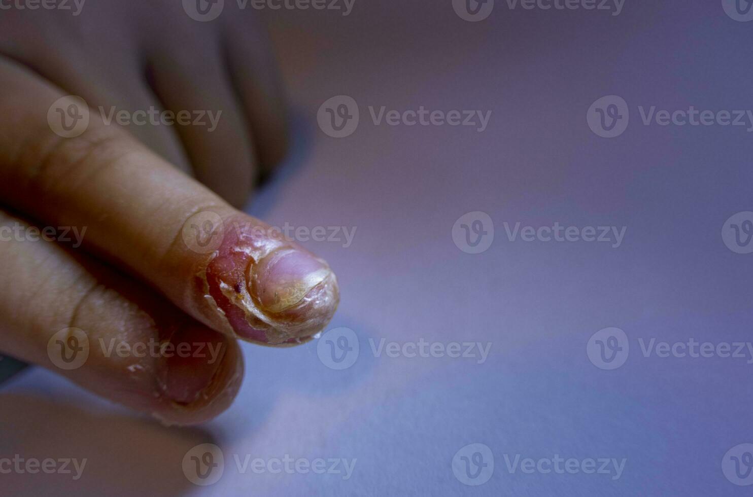 finger swollen with inflammation due to Nail ripped infection photo