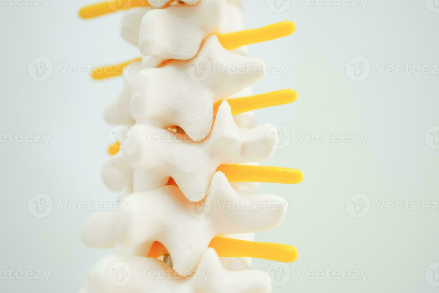 Spinal nerve and bone, Lumbar spine displaced herniated disc fragment, Model for treatment medical in the orthopedic department. photo