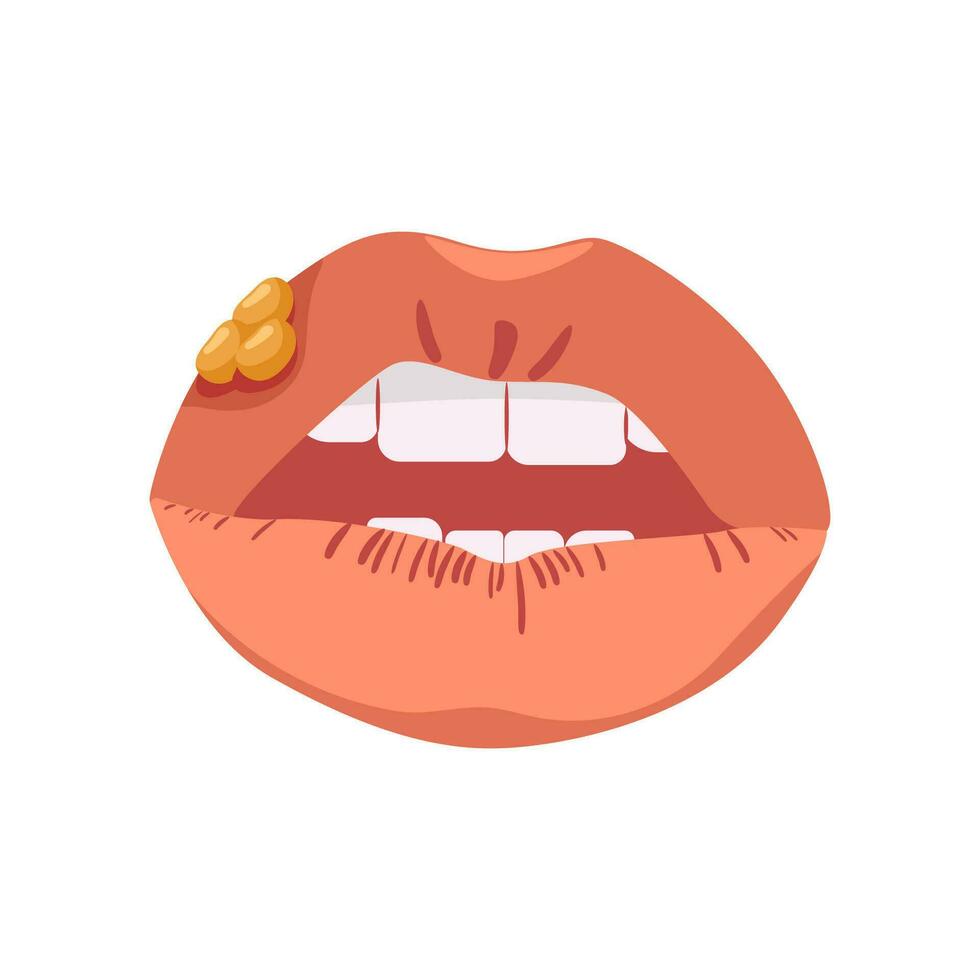 Lips with herpes. Infectious disease affecting mucous membranes in form of blisters with inflammatory ulcerative vector processes