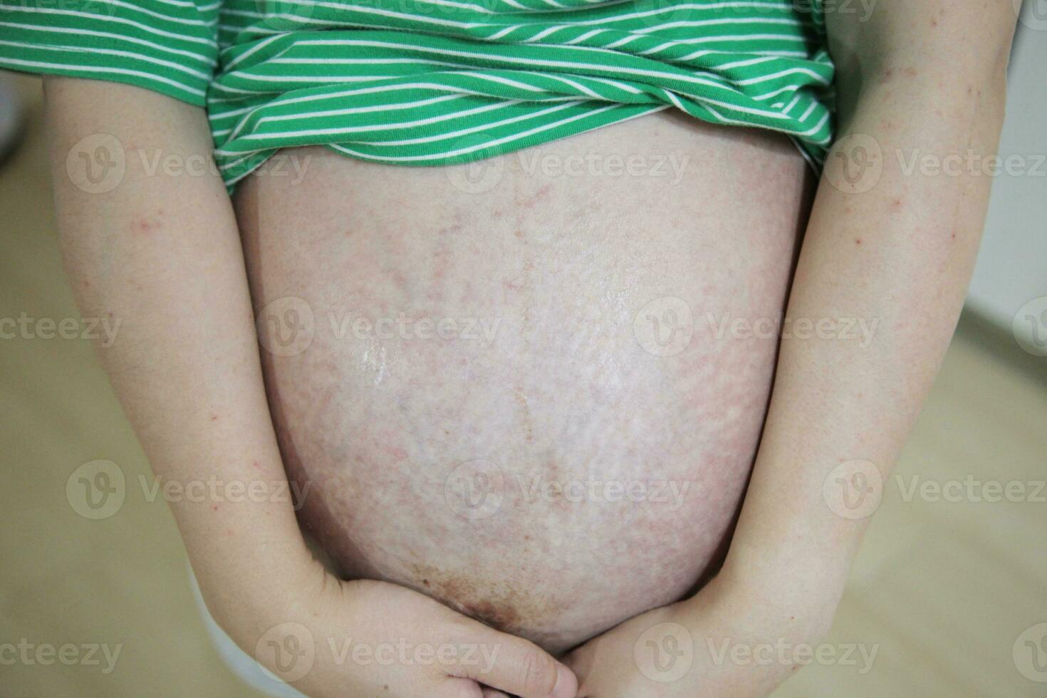 Embracing Motherhood Asian Pregnant Woman with Stretch Marks Lovingly Holds Belly photo