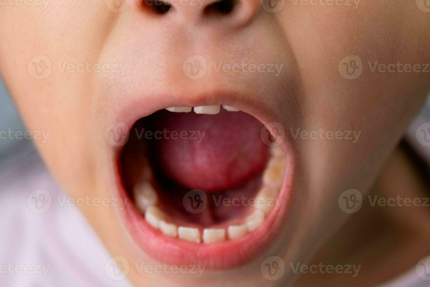 Headshot cropped image of cute preschool girl smiling wide showing milk teeth. Close-up of a child's white teeth. photo