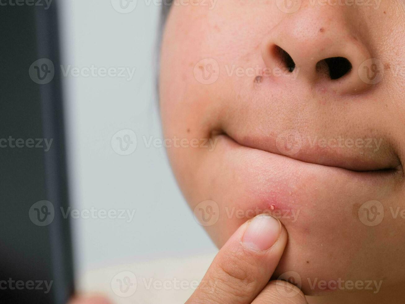 Close up of young woman squeezing pimples on her face. Problematic skin in dark-haired asian woman. Concept of skin problems and skin care. photo