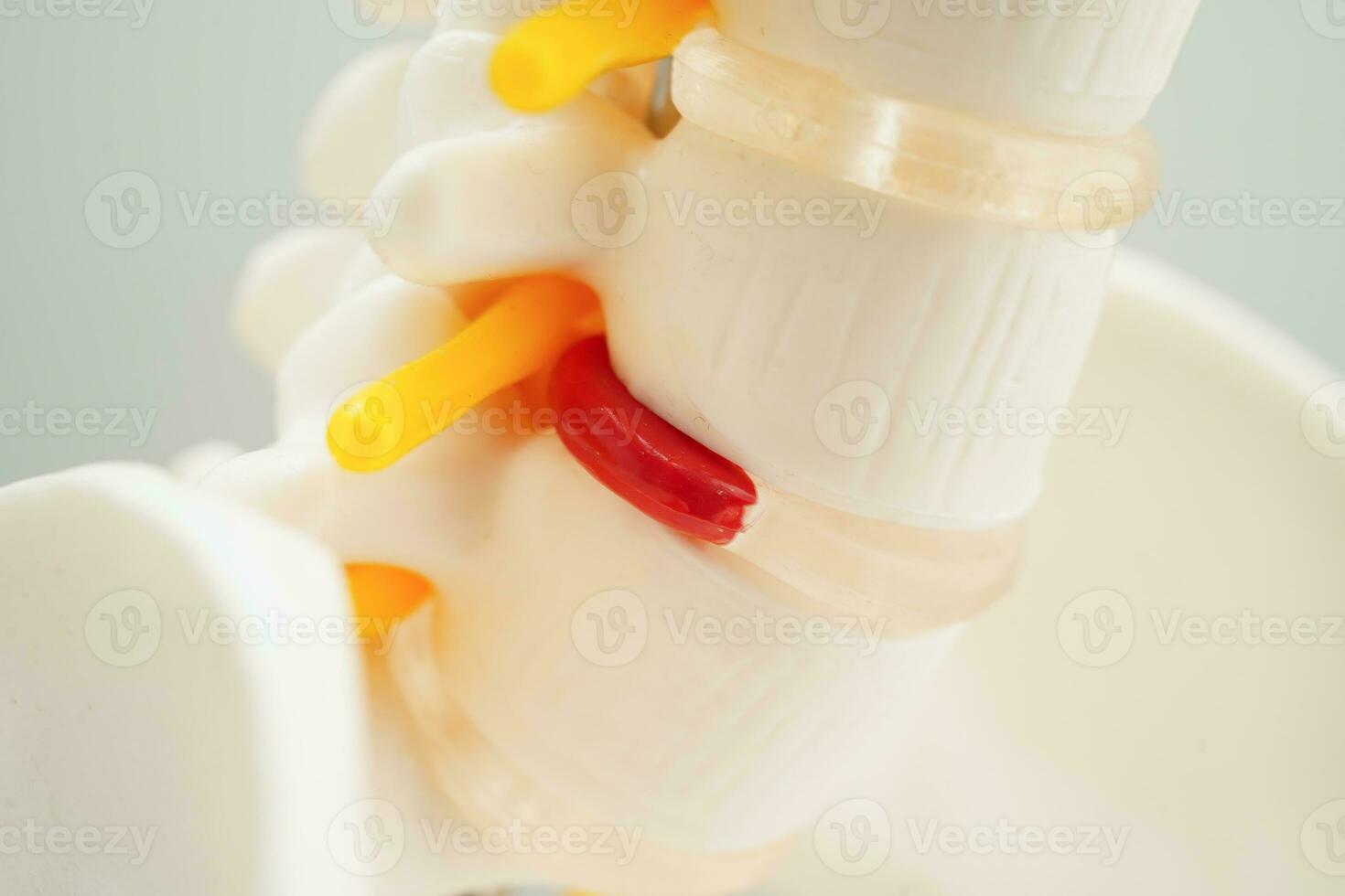 Spinal nerve and bone, Lumbar spine displaced herniated disc fragment, Model for treatment medical in the orthopedic department. photo