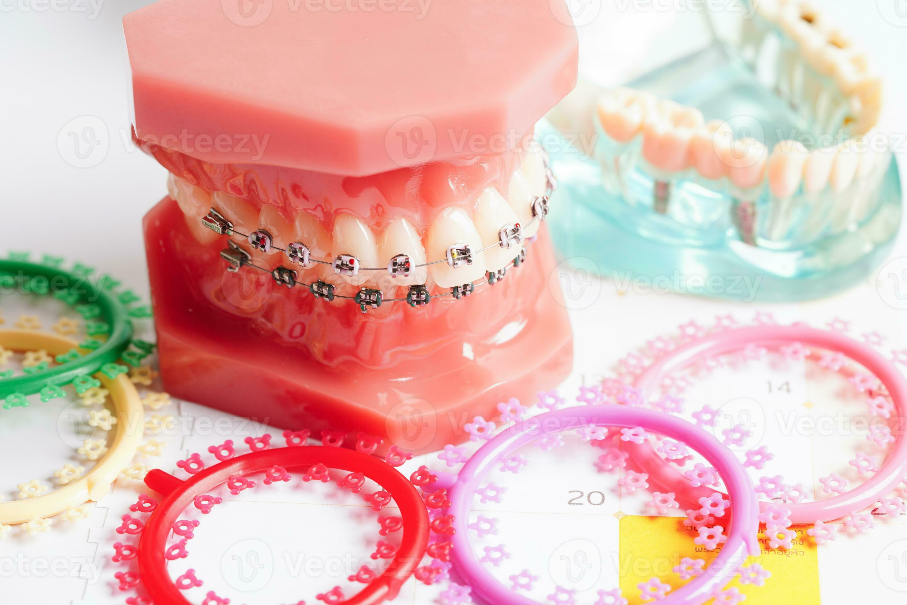 Orthodontic ligatures rings and ties, elastic rubber bands on