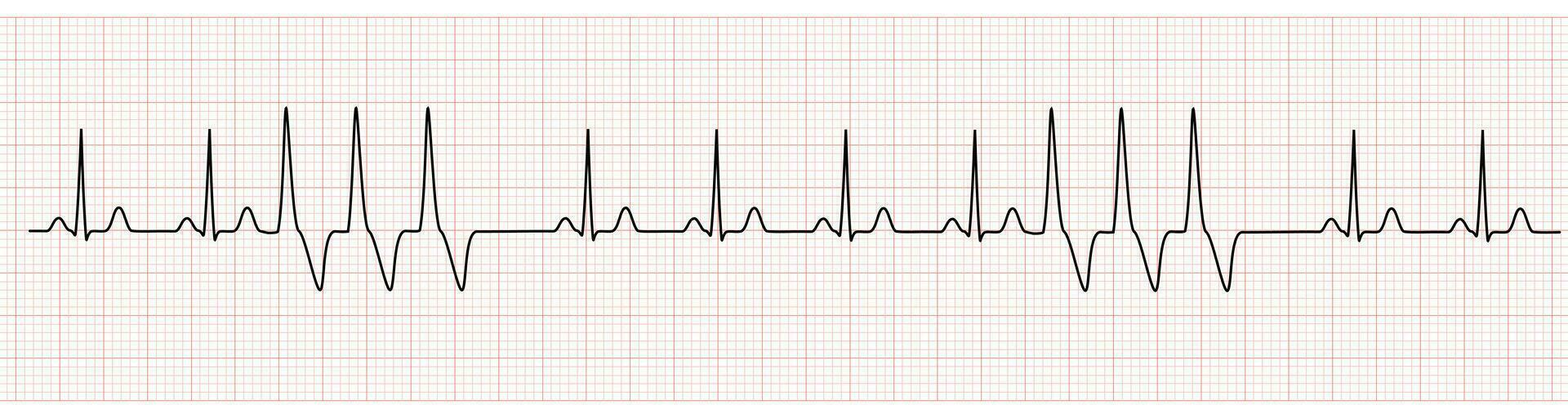 EKG Monitor Showing  Sinus Rhythm with Short Run VT vector
