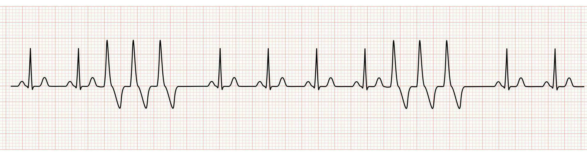 ekg monitor demostración seno ritmo con corto correr Vermont vector