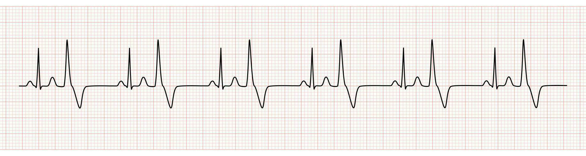 EKG Monitor Showing  Sinus Rhythm with Bigeminy PVC vector