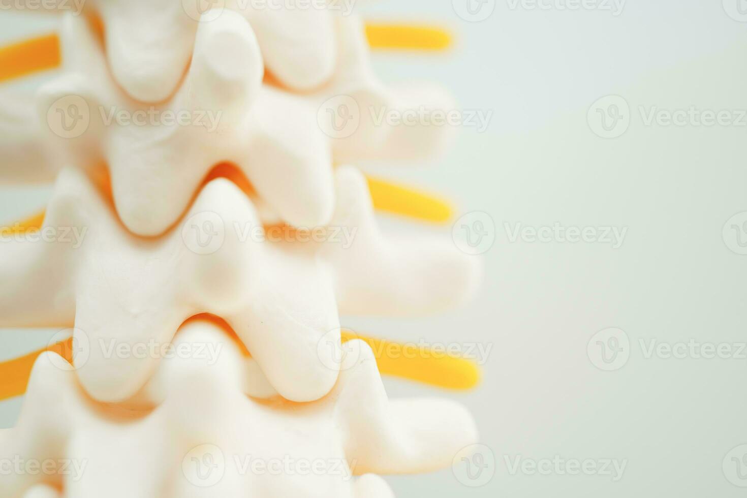 Spinal nerve and bone, Lumbar spine displaced herniated disc fragment, Model for treatment medical in the orthopedic department. photo