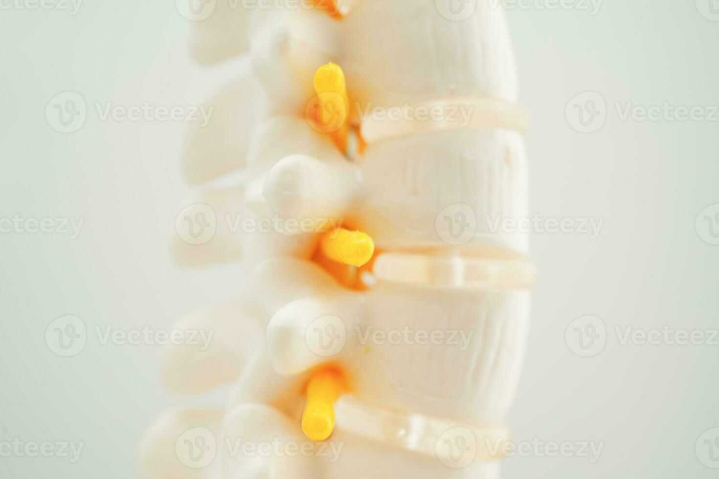 Spinal nerve and bone, Lumbar spine displaced herniated disc fragment, Model for treatment medical in the orthopedic department. photo