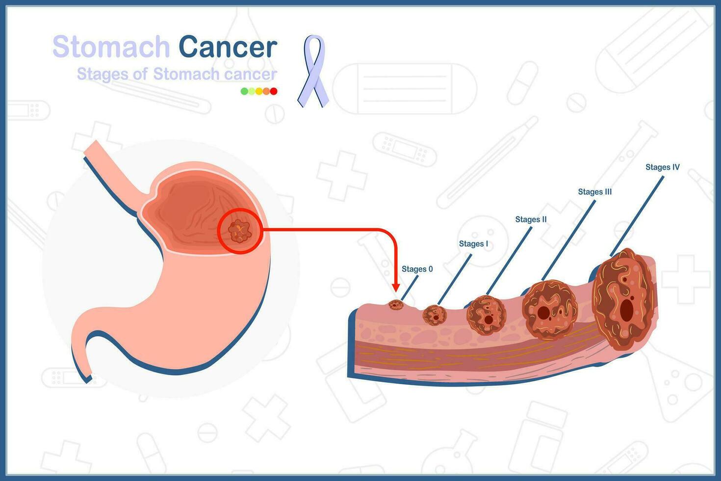 Medical vector illustration concept in flat style of stomach cancer. 5 stages of stomach cancer and stomach tumor illustration.isolated on white background.