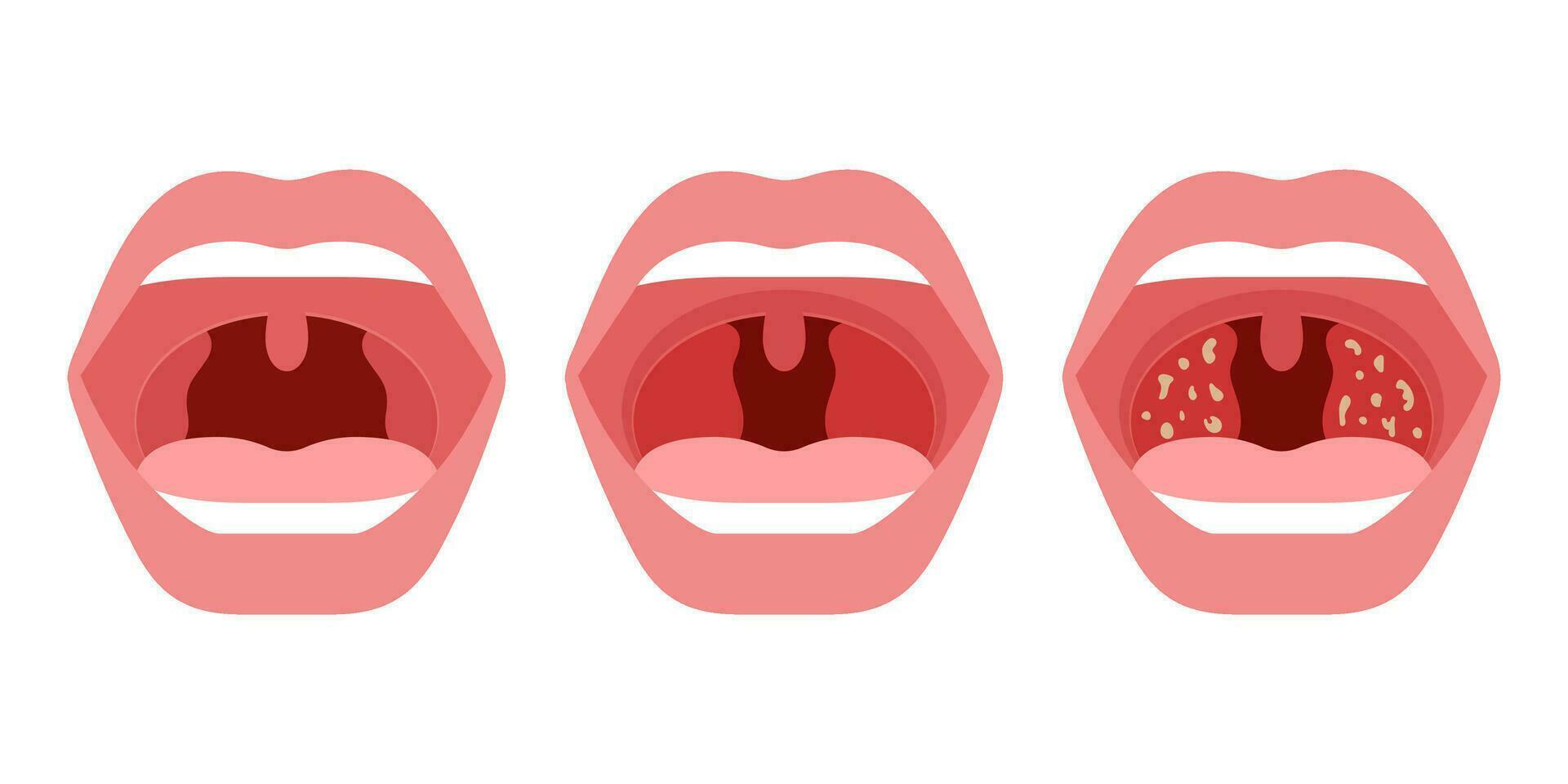 Open mouth with health and sick throat of human. Comparison healthy throat, tonsillitis bacterial and viral. Infection, redness of tonsils. Inflammation and pain airway. Vector illustration