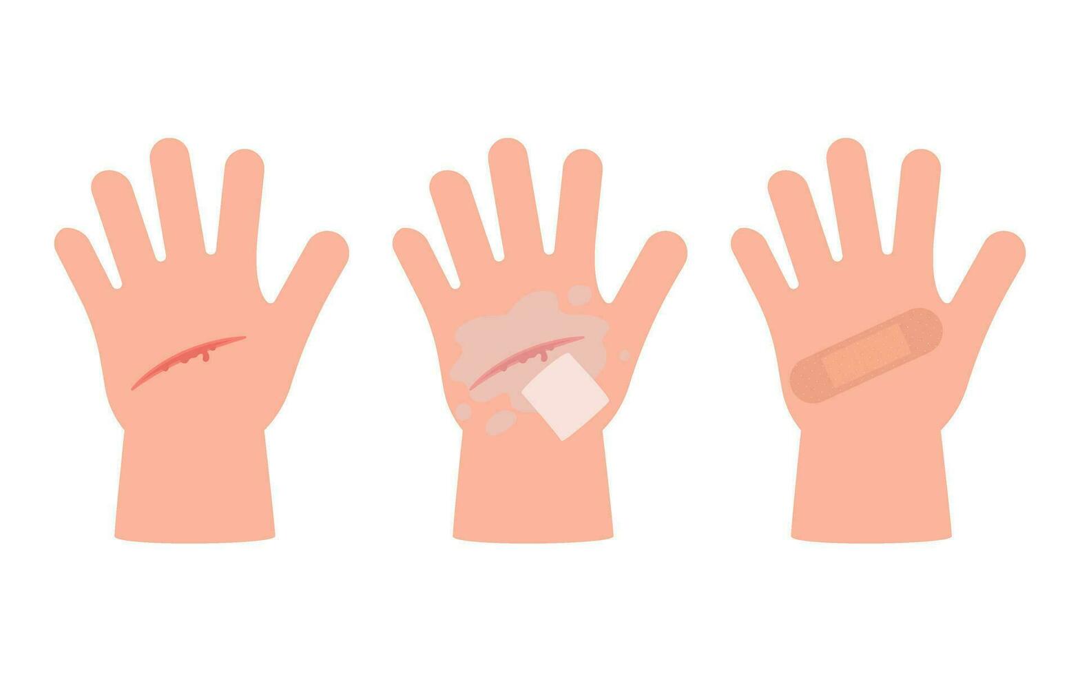 Wound of hand kid skin, scratch. First aid for cut injury skin, bleeding cut. Clean and disinfection wound, patch for safe health. Vector illustration