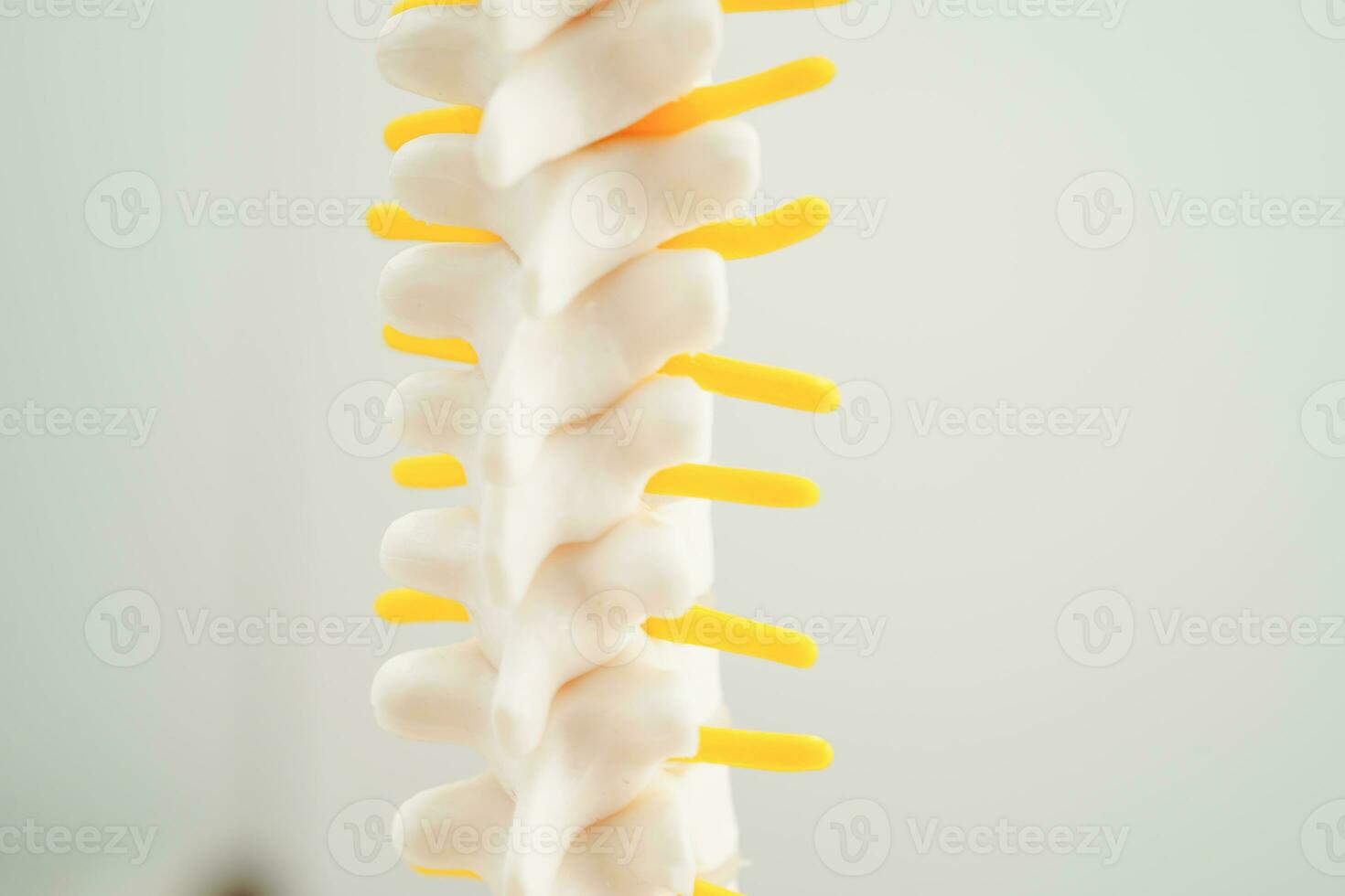 Spinal nerve and bone, Lumbar spine displaced herniated disc fragment, Model for treatment medical in the orthopedic department. photo