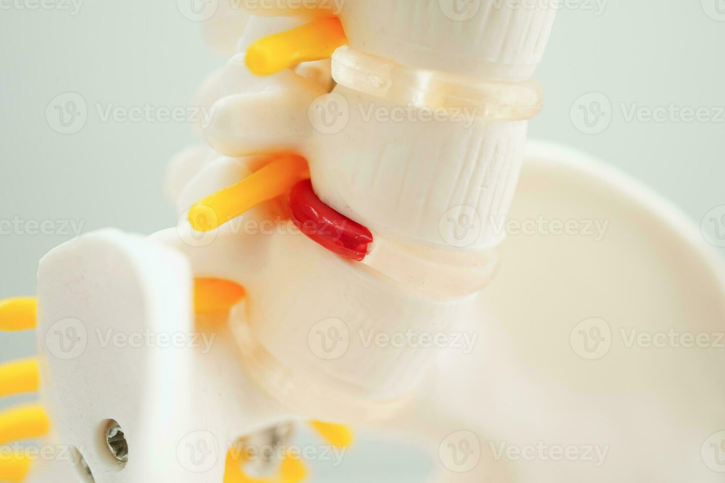 Spinal nerve and bone, Lumbar spine displaced herniated disc fragment, Model for treatment medical in the orthopedic department. photo