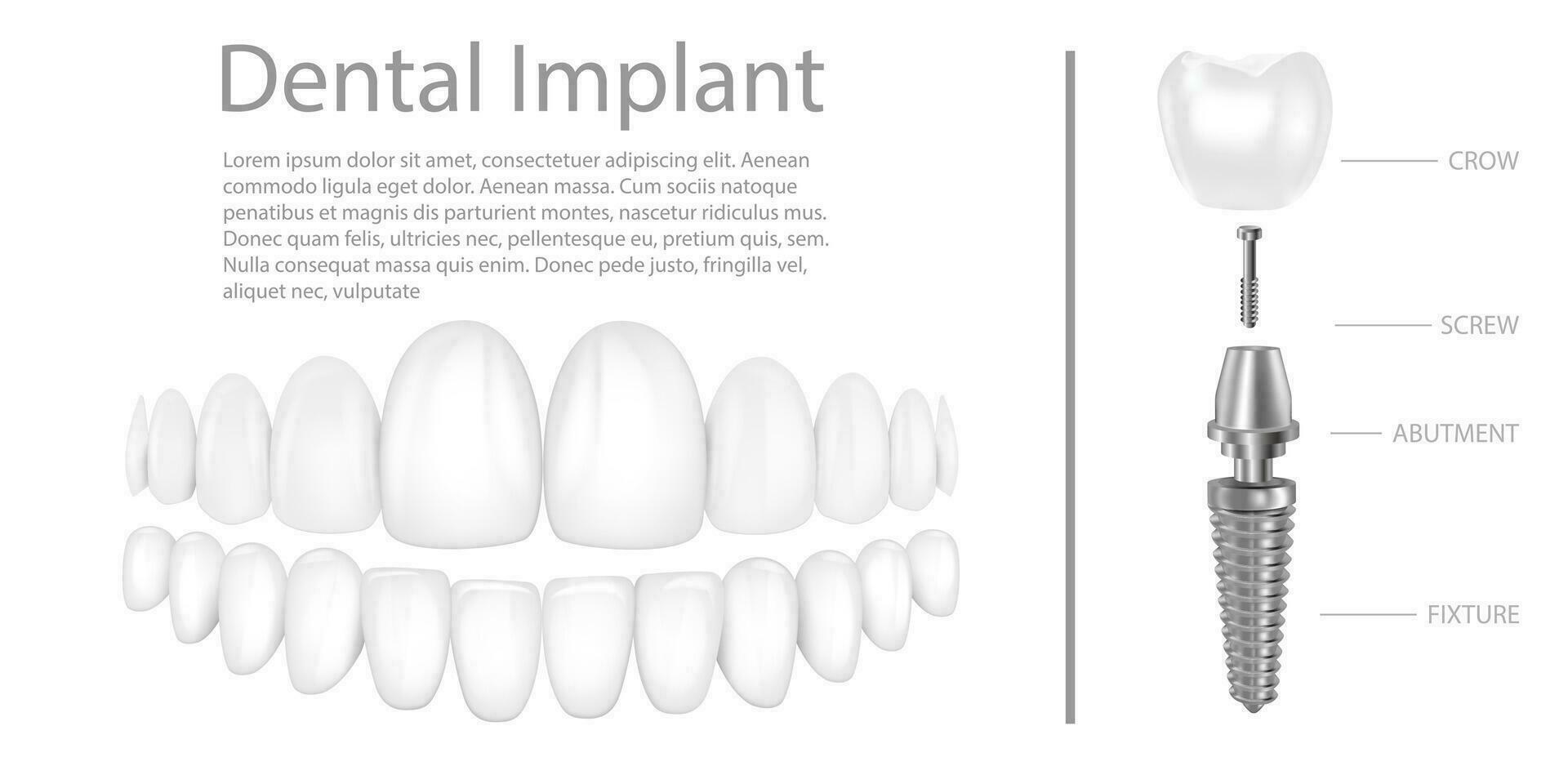 Dental implant structure medical pictorial educative infographic poster with molar replacement end healthy tools models vector illustration.