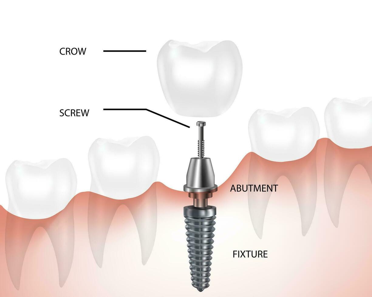Dental implant component parts, tooth denture components, vector. vector