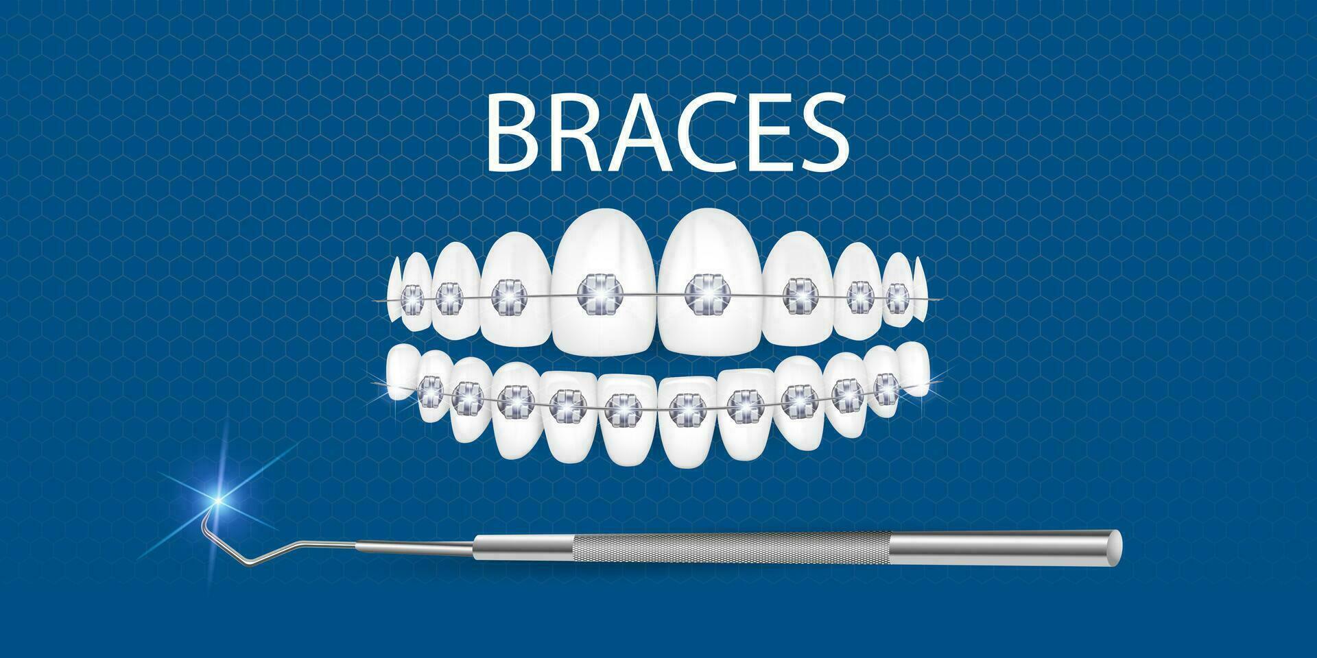 3d vector illustration, realistic teeth with braces. Alignment of the bite of teeth, dentition with braces, dental braces.