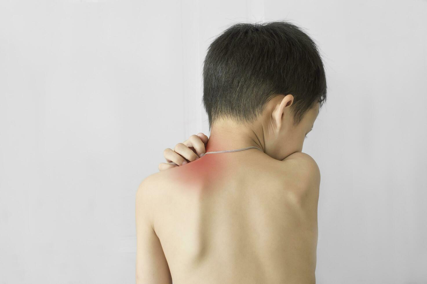 a young boy with a red rash on his back photo