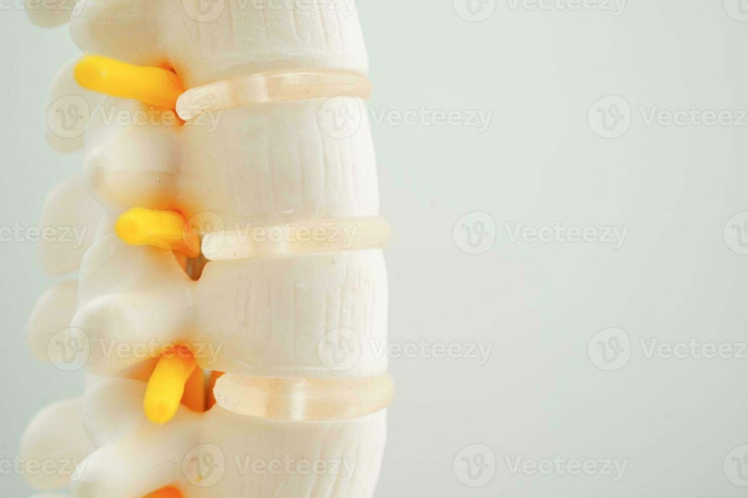 Spinal nerve and bone, Lumbar spine displaced herniated disc fragment, Model for treatment medical in the orthopedic department. photo