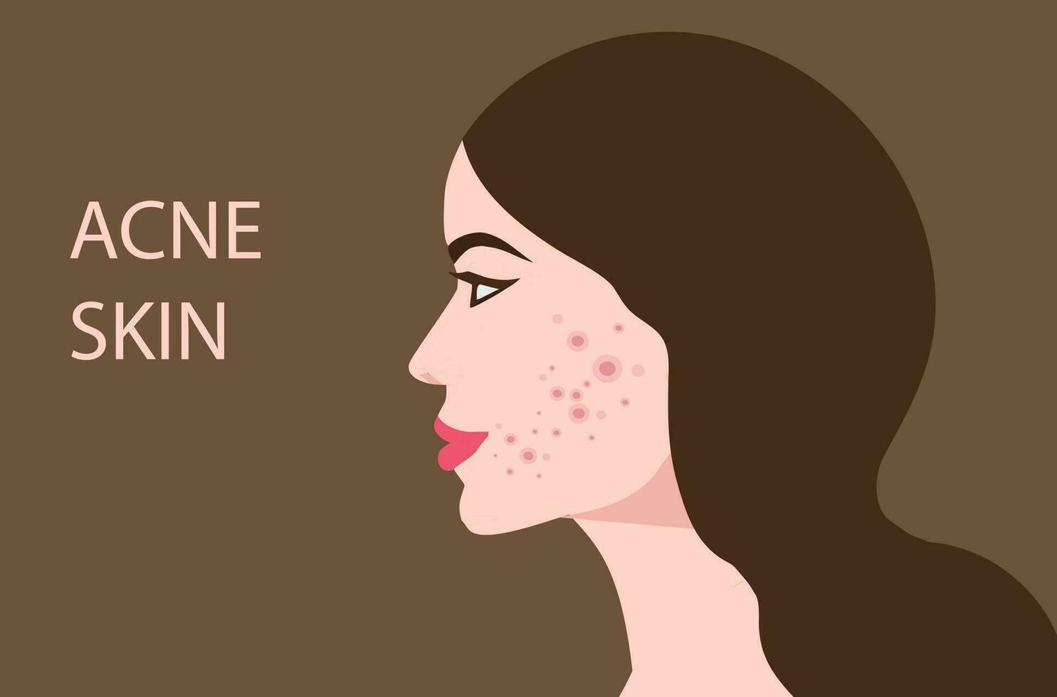 Woman face with skin acne, pimples, blackheads vector illustration.